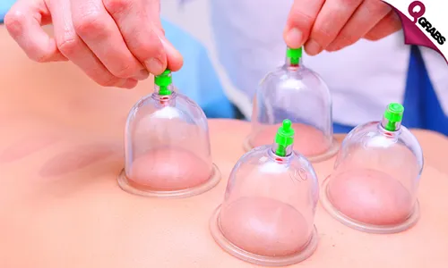 Full Body Wet Cupping/Hijama at Family Medical Polyclinic!